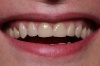 VOLLKERAMIKKRONEN: fügen sich natürlich in die Zahnreihe ein