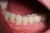 EINZELKRONEN: auf Implantaten und natürlichen wurzelbehandelten Zähnen