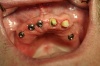 FALL 2: Zahnersatz mit Implantaten in Kombination mit natürlichen Zähnen