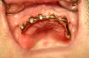 FALL 2: Zahnersatz mit Implantaten in Kombination mit natürlichen Zähnen