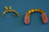 FALL 2: Darstellung der Konstruktion - Die natürlichen Zähne werden über Galvanokäppchen eingebunden