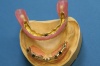 FALL 3: Wiederherstellung eines zahnlosen Kiefers mit einer steggetragenen, gaumenfreien Prothese
