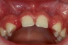 NICHTANLAGE von Zähnen - Fall 1: Nichtanlage der oberen, seitlichen Schneidezähne; kieferorthopädische Behandlung ist abgeschlossen