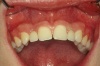 NICHTANLAGE von Zähnen - Fall 1: Lückenschluss mittels Matallkeramikkronen auf Implantaten