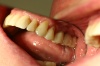  BRÜCKE - Fall 1: Spiegelaufnahme mit eingesetzten Zähnen von der Seite