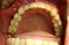 BRÜCKE - Fall 1: Die Spiegelaufnahme zeigt den vollständig wiederhergestellten Zahnbogen