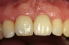 FRONTZAHN-EINZELKRONE - Fall 1: Eingegliederte Vollkeramikkrone auf Implantat - Welcher Zahn ist hier nicht natürlich?!