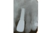 FRONTZAHN-EINZELKRONE - Fall 1: Röntgenbild mit definitiver Keramikkrone