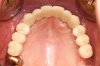 ZAHNLOSER KIEFER - Fall 2: Die Spiegelaufnahme zeigt den vollständig wiederhergestellten Zahnbogen - Nach der Einheilzeit der Implantate konnten wieder feste Zähne eingesetzt werden. 