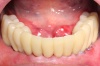 ZAHNLOSER KIEFER - Fall 1: Eingesetzte Brücke am Tag nach der Operation, d.h. feste Zähne innerhalb von 24 h.