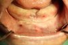 ZAHNLOSER KIEFER - Fall 1: Zahnloser Unterkiefer mit totaler Atrophie als Ausgangssituation