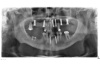Postoperatives Bild nach Implantation im Ober- und Unterkiefer mit Knochenaufbau - im Oberkiefer (Kieferhöhle) mit Knochenersatzmaterial und im rechten Unterkiefer mit einem Knochenblock.