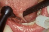 Verkürztes Zungenbändchen mit Funktionseinschränkung der Zungenbewegung